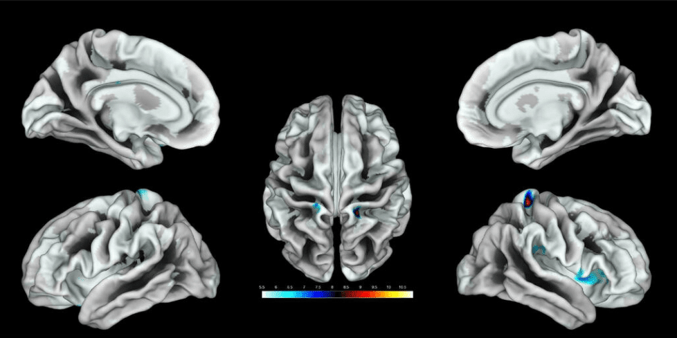 Location of the brain region activated by clitoral stimulation in a group of women.  / Knop et al., JNeurosci 2021